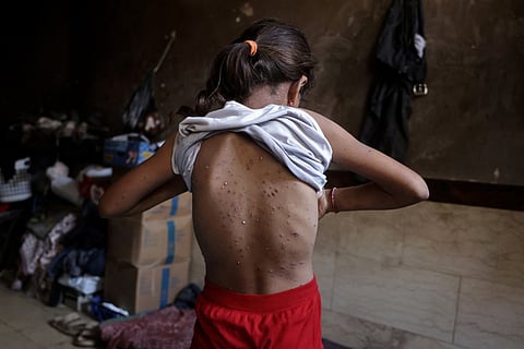 A displaced Palestinian girl, who according to doctors is suffering from chickenpox, shows rashes on her back as she stands inside her family's tent in Khan Yunis, in the southern Gaza Strip, on July 19, 2026.