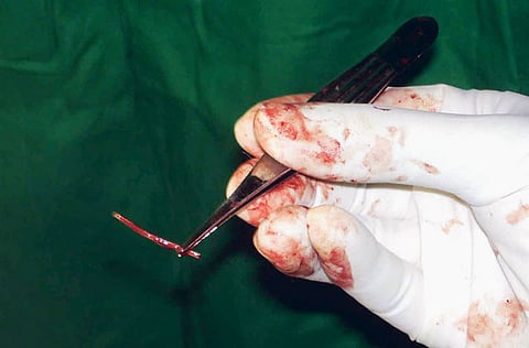 Doctors in the Iraqi city of Sulaymaniyah successfully removed 24 sharp objects from a man's stomach. Picture for illustrative purposes only.