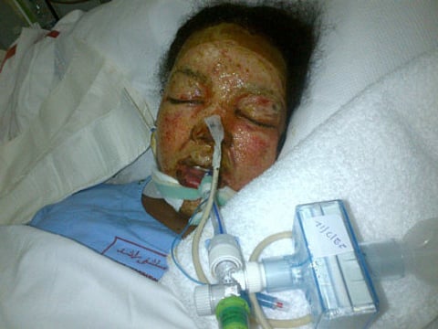 Maid injured in kitchen accident dies