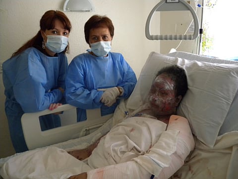 Woman suffers 90% burns after taking antibiotic