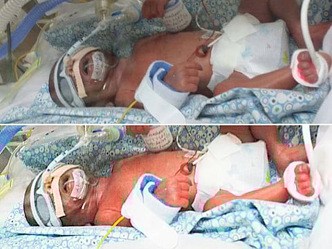 Twin girls born prematurely at 26 weeks. The babies weighed 800g at birth.