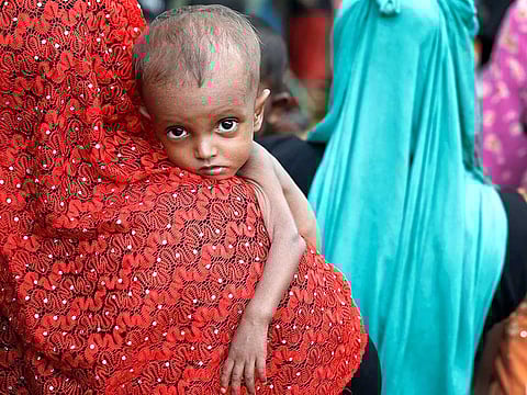 A malnourished Rohingya refugee in Cox's Bazar, Bangladesh.