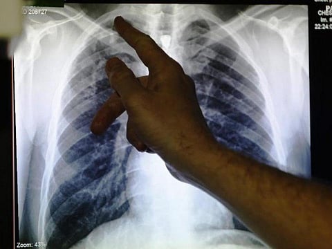 Smart system to detect TB makes brisk progress