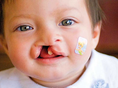 Operation Smile UAE