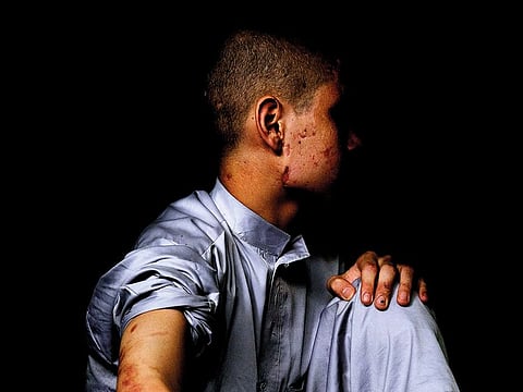 Shakur, a 14-year-old from Kunduz, with cuts and bruises from a bomb that had accidentally blown up in his face