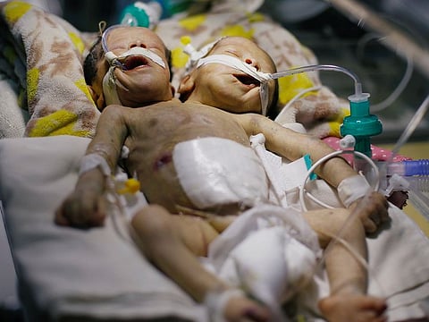 Newly born conjoined twins lie in an incubator at the child intensive care unit of Thawra hospital in Sanaa
