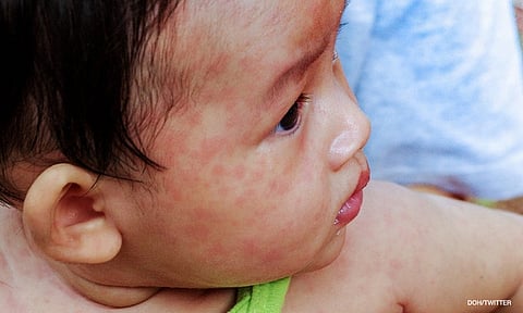 From January to Febuary this year, 424 measles cases were recorded in Bicol region, of which six of the affected children had died of the disease.