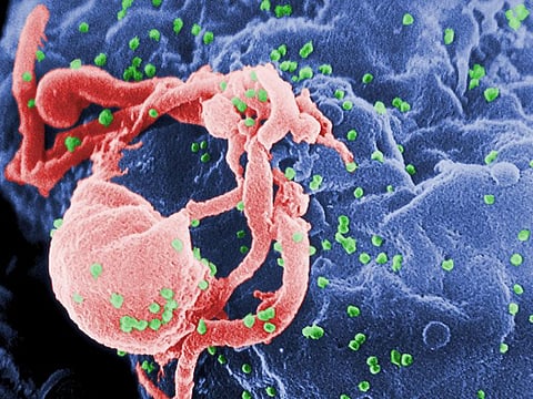 This scanning electron microscopic (SEM) image shows the presence of numerous human immunodeficiency virus-1 (HIV-1) virions (spherical in appearance) budding from a cultured human lymphocytes in this 1989 image obtained from Centers for Disease Control and Prevention (CDC) in Atlanta, Georgia.
