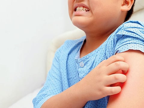 Like adults, children too get red scaly patches and plaques on elbows, knees and scalp; but unlike grown-ups, children’s face and even eyelids can get affected