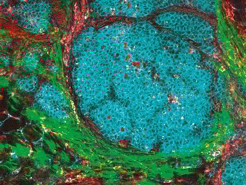 An image of a breast cancer tumour and its microenvironment. For illustrative purposes only.