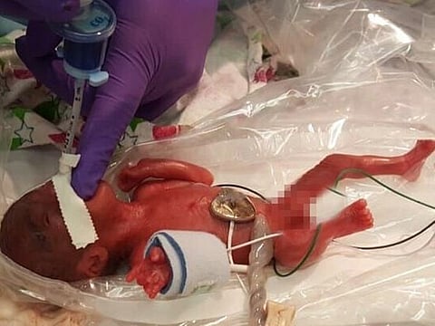 Baby Saybie, the world's smallest surviving newborn, when she was born in December 2018 in San Diego, California.