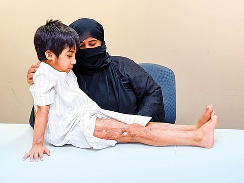 Abdul Rahman, who suffered third-degree burns after he opened an acid bottle kept at home, with his grandmother.