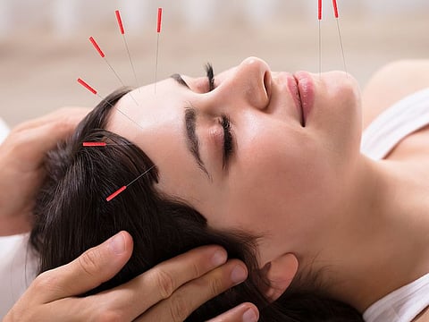 Acupuncture is one of many popular traditional Chinese medicine solutions for pain alleviation