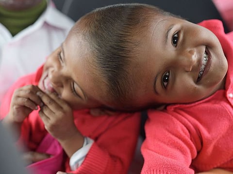 This handout photograph taken on January 5, 2019 and received on August 2 from the Action for Defenceless People Foundation (ADPF) shows conjoined Bangladeshi twins Rabeya and Rukaya during their visit to Budapest, in preparation for their final separation surgery in Dhaka.