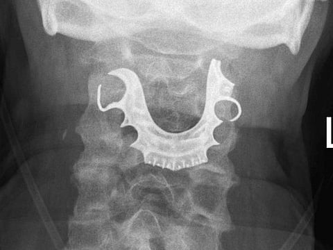 This undated X-ray image shows dentures stuck in the throat of a 72-year-old patient. Illustrative image.
