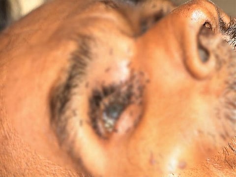 Ants crawling inside an eye of Balchandra Lodhi after his death at Shivpuri district hospital in Madhya Pradesh.