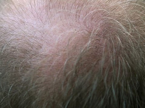 Over the past week, men and women from Borgaon, Kalwad and Hingna, located in the Shegaon tehsil, have reported losing their hair in large patches.