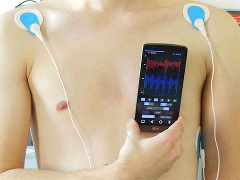 The accelerometers inside a smartphone can be used to acquire a signal associated with mechanical cardiac activity