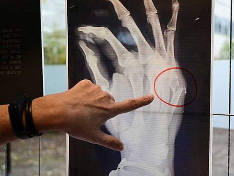 File image: A doctor points to a x-ray of a woman's hand broken small metacarpal bone