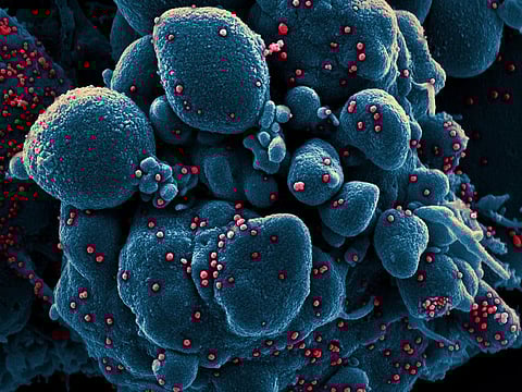 A colored scanning electron micrograph provided by the National Institute of Allergy and Infectious Diseases shows a dying cell infected with the coronavirus, with viral particles in red. A preliminary report posted online claimed that a mutation had made the virus more transmissible. Geneticists say the evidence isn’t there.