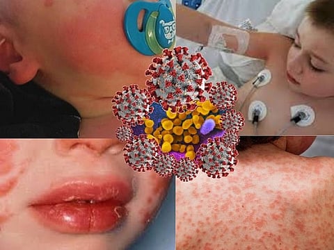 The Multi-System Inflammatory Syndrome in Children (MISC), similar to 'Kawasaki Disease', is presenting in children who have recovered from COVID-19, or been exposed to people suffering from COVID-19. MISC is now believed to have impacted approximately 300 US children. The number of could be higher, if cases in Italy, Britain and elsewhere were to be accounted for.