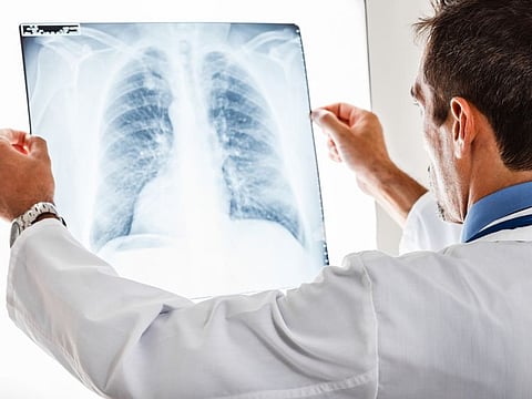 Scientists revive damaged lungs for transplant