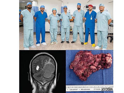The Tawam Hospital team (top) that successfully removed the mega tumour from the woman's brain
