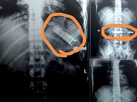 Image run by Egyptian media purportedly showing a mobile phone inside an Egyptian man's body.