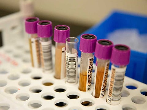 Convalescent plasma samples in vials are seen before being tested for COVID-19 antibodies at the Bloodworks Northwest Laboratory during the coronavirus disease (COVID-19) outbreak in Renton, Washington, US, September 9, 2020.