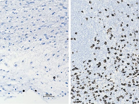 Immune cells within in the brain tumor of a child, before and after a treatment that involves using viruses to spur an immune system response to the cancerous cells.