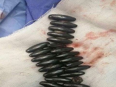 Metal objects which were retrieved from the child's stomach.