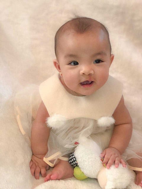 Antheia after the surgery to rectify her cleft lip -- an opening in the upper lip.