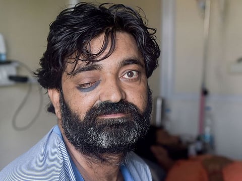 A patient infected by black fungus receives treatment at a hospital in Ghaziabad, India, on May 28, 2021.