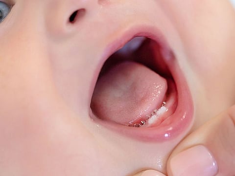 In a small ten-minute light sedation procedure, Dr Sharma cleared the fibrotic band, freeing the tongue and also making sure the condition did not develop again.