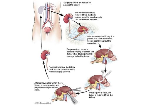 After accessing the tumour and removing it under strong magnification, the surgeons repaired Shamsi’s kidney and began the delicate work of transplanting it back into his body.