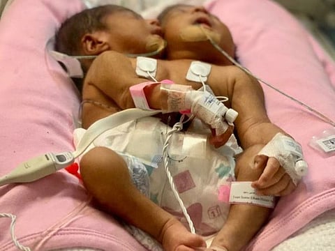 The conjoined twins, born in Mecca, Saudi Arabia.