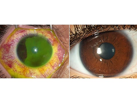 Left: The patient’s eye with ocular injury caused due to exposure to hand sanitiser. Right: The patient’s eye after full recovery.