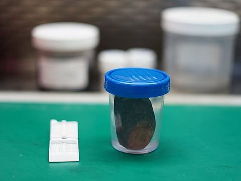 A gallstone measuring 7cm was extracted from a 52-year-old Iraqi expatriate woman in Dubai.