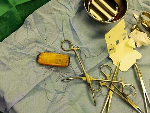 He was immediately taken to the operation theatre. The two-hour long surgery was a success, and the phone was removed.