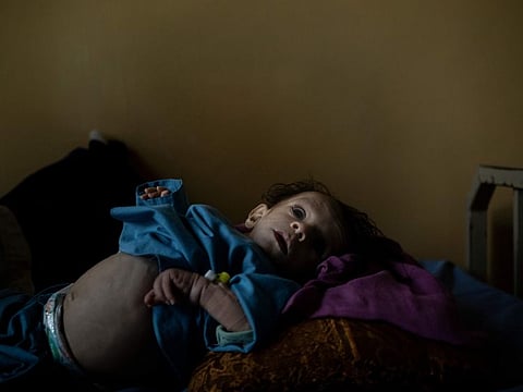 One-year-old Mohebullah lies on a hospital bed after he almost died of malnutrition in Mirbacha Kot, Afghanistan on October 24, 2021. Health care workers continue to work without salaries, without medicine and with frequent power cuts as Afghanistan's economy crumbles.