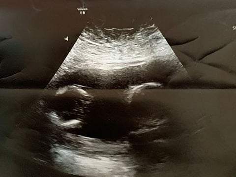 Shamila H's treasured sonogram.