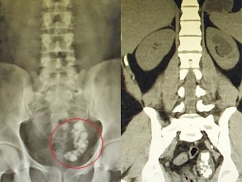 An Indian expatriate in Abu Dhabi, who had nearly 40 stones blocking his ureter, has had the obstruction removed without a single incision.