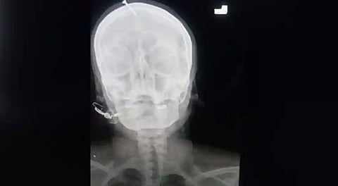 An ex-ray shows the nail in woman's head.