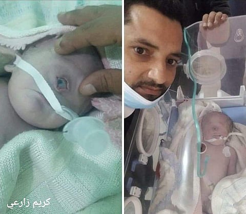 The one-eyed baby allegedly inside a Yemeni hospital.