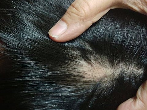 Sarah Gul's daughter was diagnosed with alopecia when she was five.