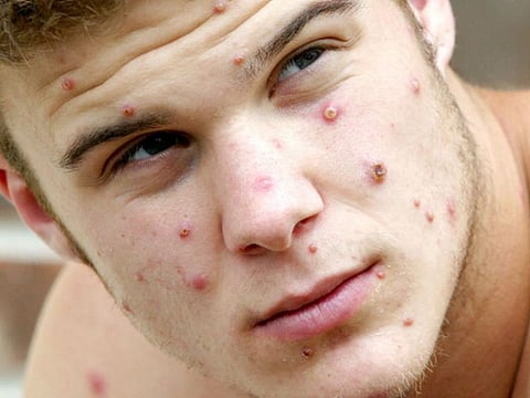 High school student Julian Glenn was believed to have contracted the monkeypox virus from his pet prairie dog, John, in this file photo taken in 2003.