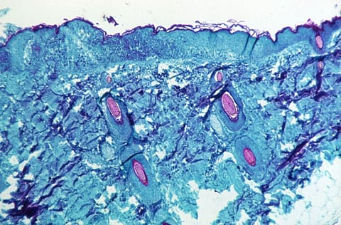 A section of skin tissue, harvested from a lesion on the skin of a monkey, that had been infected with monkeypox virus, is seen at 50X magnification on day four of rash development in 1968.