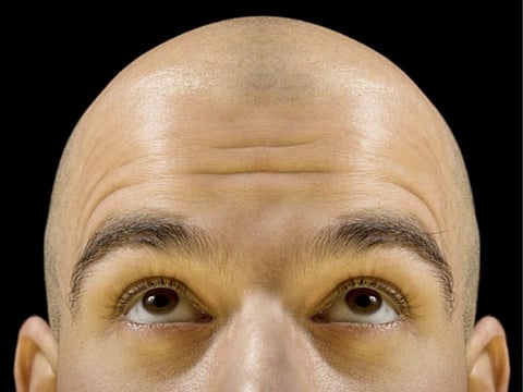 AUTO-IMMUNE DISEASE: With alopecia, which afflicts tens of millions of people, cells in your immune system surround and “attack” your hair follicles — the part of your body that makes hair. This causes the attached hair to fall out, often in clumps.