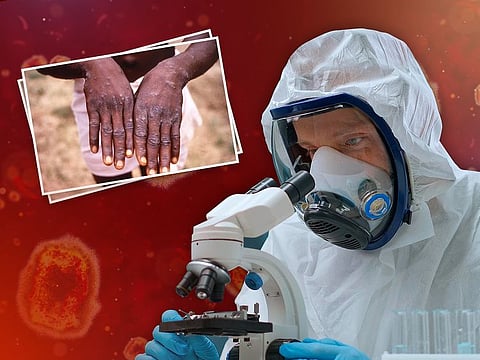 The mpox strain known as the Clade Ib subclade causes skin rashes across the whole body, unlike other strains where lesions and rashes are usually limited to the mouth, face and genitals.