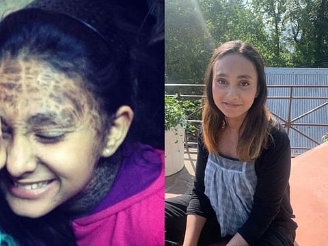 (Left) Laiba Mateen is a child with scales on her forehead and deeper scales on neck and shoulders; (Right) her face, neck and arms are clear.